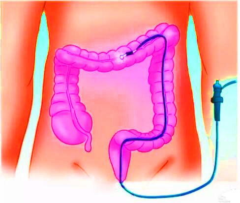 直腸癌早期有哪些癥狀？